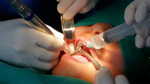 Cirugía Oral - MAXILOIMPLANT
