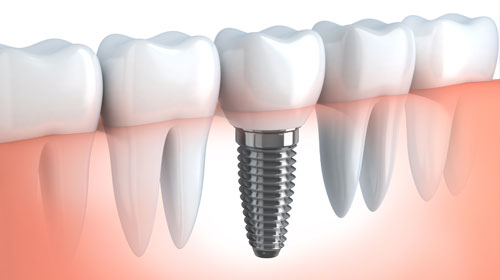 Implantes Dentales - MAXILOIMPLANT